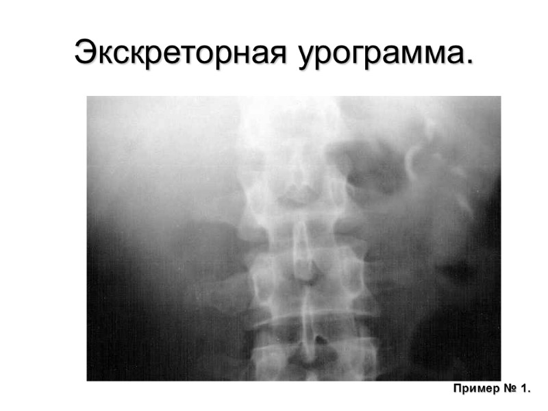 Экскреторная урограмма. Пример № 1.